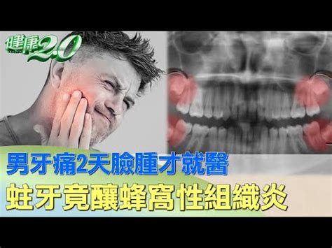 牙痛腫起來|蜂窩性組織炎: 你的牙痛臉腫，嚴重時也可能危及生命。